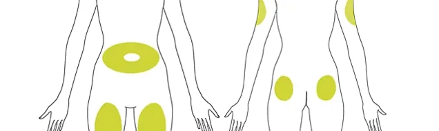 2D image of front and back body shots with the sites of injection highlighted.