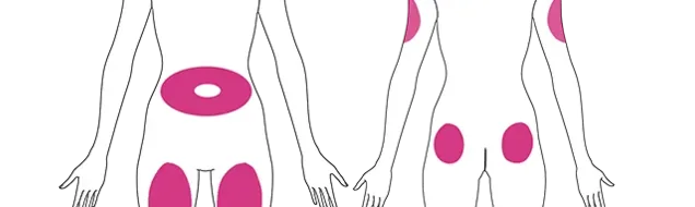 2D image of front and back body shots with the sites of injection highlighted.