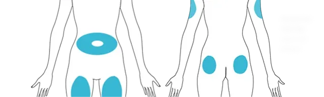 2D image of front and back body shots with the sites of injection highlighted.